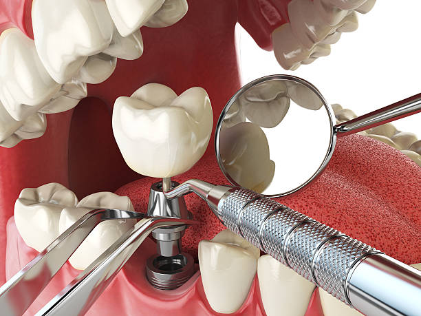 Best Emergency Treatment for Dental Infections or Abscesses in Hidden Meadows, CA